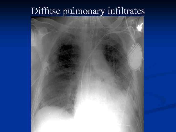 Diffuse pulmonary infiltrates 