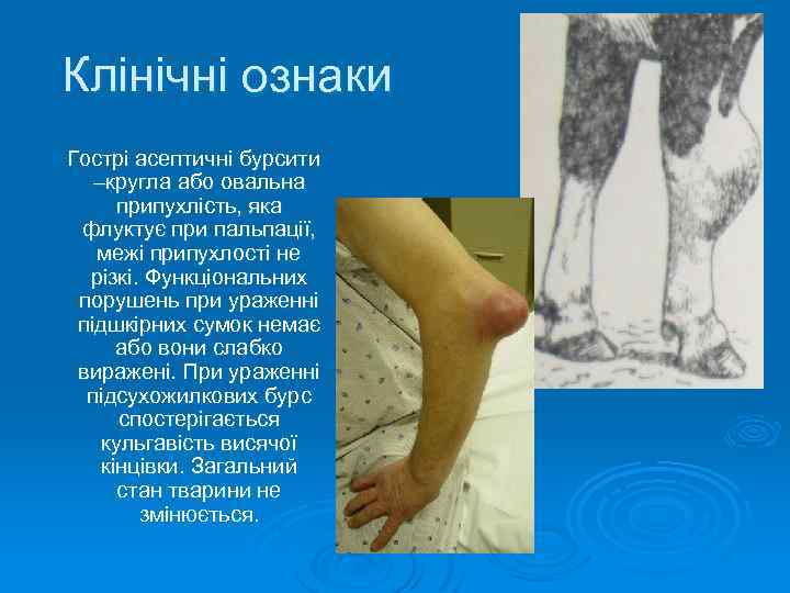 Клінічні ознаки Гострі асептичні бурсити –кругла або овальна припухлість, яка флуктує при пальпації, межі