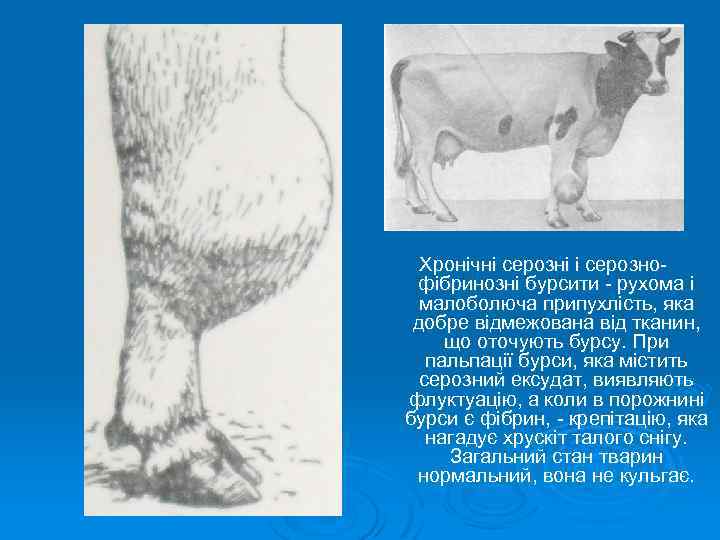 Хронічні серозні і серознофібринозні бурсити - рухома і малоболюча припухлість, яка добре відмежована від