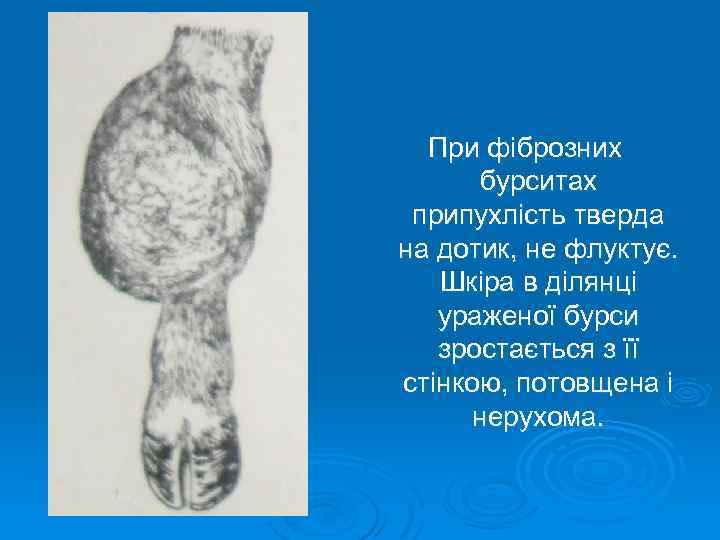 При фіброзних бурситах припухлість тверда на дотик, не флуктує. Шкіра в ділянці ураженої бурси
