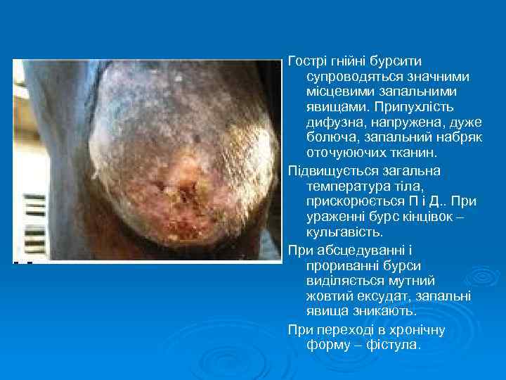 Гострі гнійні бурсити супроводяться значними місцевими запальними явищами. Припухлість дифузна, напружена, дуже болюча, запальний