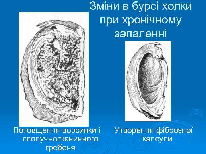 Зміни в бурсі холки при хронічному запаленні Потовщення ворсинки і сполучнотканинного гребеня Утворення фіброзної