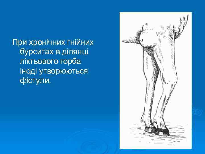 При хронічних гнійних бурситах в ділянці ліктьового горба іноді утворюються фістули. 