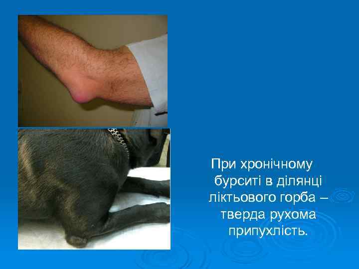 При хронічному бурситі в ділянці ліктьового горба – тверда рухома припухлість. 