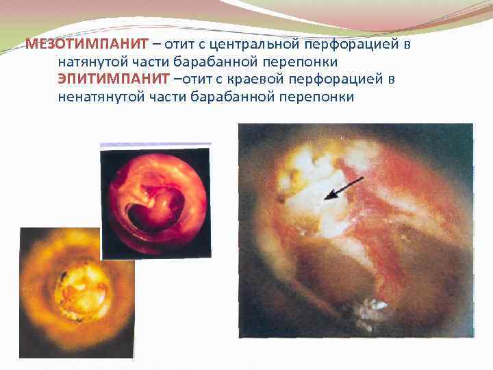 МЕЗОТИМПАНИТ – отит с центральной перфорацией в натянутой части барабанной перепонки ЭПИТИМПАНИТ –отит с