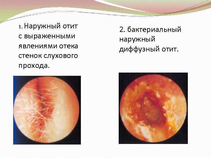 1. Наружный отит с выраженными явлениями отека стенок слухового прохода. 2. бактериальный наружный диффузный