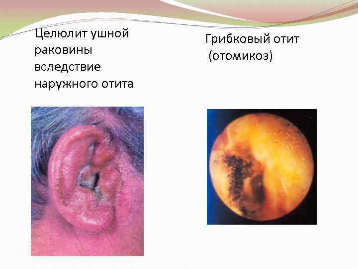 Целюлит ушной раковины вследствие наружного отита Грибковый отит (отомикоз) 