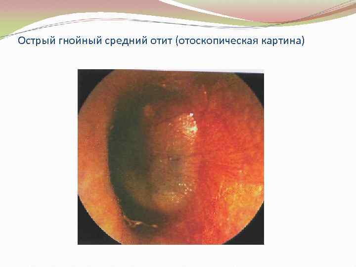 Острый гнойный средний отит (отоскопическая картина) 