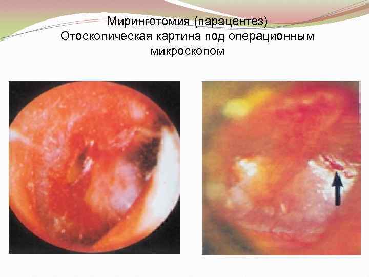 Миринготомия (парацентез) Отоскопическая картина под операционным микроскопом 