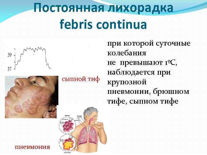 Постоянная лихорадка febris continua при которой суточные колебания не превышают 1ºС, наблюдается при сыпной