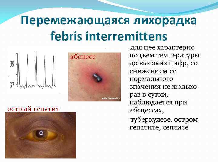 Перемежающаяся лихорадка febris interremittens абсцесс острый гепатит для нее характерно подъем температуры до высоких