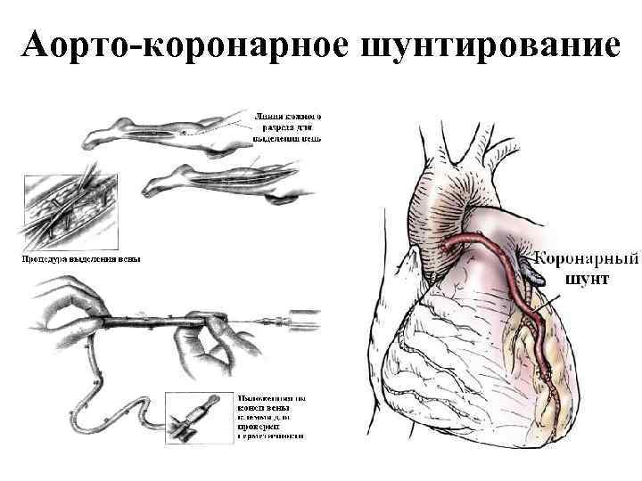 Аорто-коронарное шунтирование 