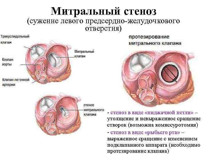 Митральный стеноз (сужение левого предсердно желудочкового отверстия) стеноз в виде «пиджачной петли» – утолщение