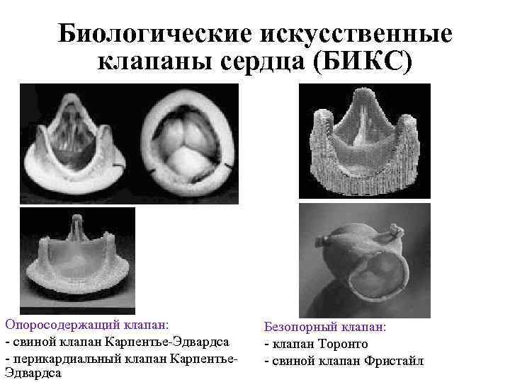 Биологические искусственные клапаны сердца (БИКС) Опоросодержащий клапан: свиной клапан Карпентье Эдвардса перикардиальный клапан Карпентье