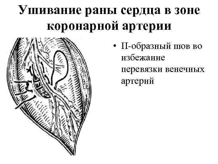Ушивание раны сердца в зоне коронарной артерии • П образный шов во избежание перевязки