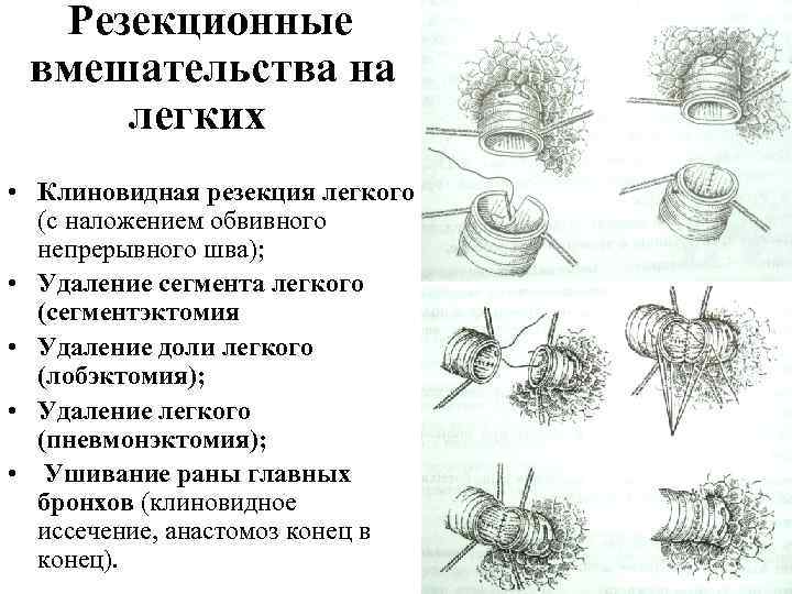 Резекционные вмешательства на легких • Клиновидная резекция легкого (с наложением обвивного непрерывного шва); •
