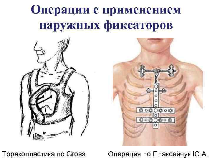 Операции с применением наружных фиксаторов Торакопластика по Gross Операция по Плаксейчук Ю. А. 