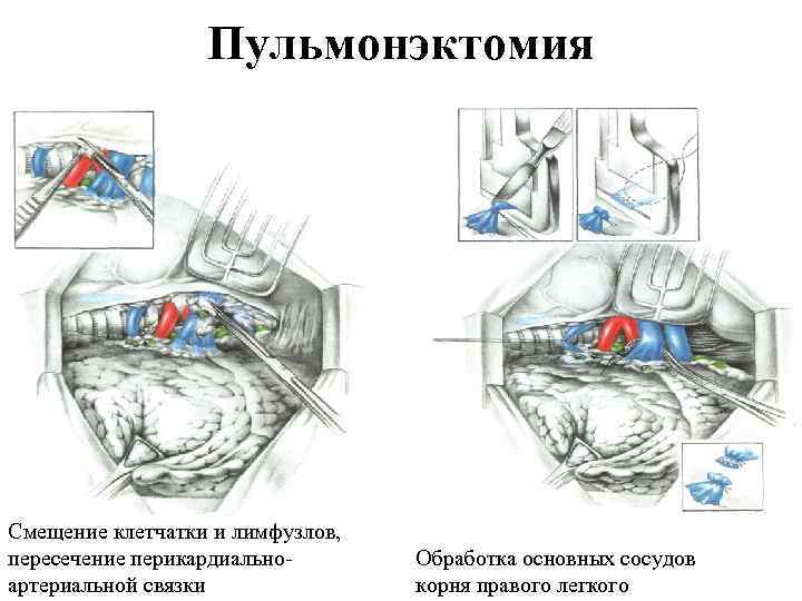 Пульмонэктомия Смещение клетчатки и лимфузлов, пересечение перикардиально артериальной связки Обработка основных сосудов корня правого