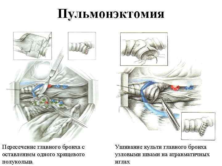 Пульмонэктомия Пересечение главного бронха с оставлением одного хрящевого полукольца Ушивание культи главного бронха узловыми