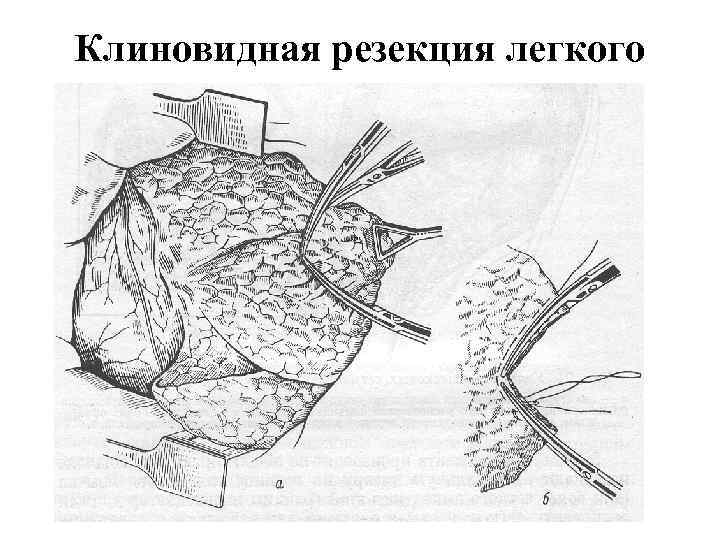 Клиновидная резекция легкого 