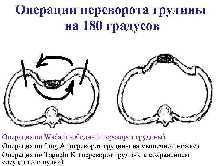 Операции переворота грудины на 180 градусов Операция по Wada (свободный переворот грудины) Операция по