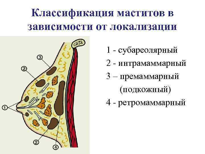 Классификация маститов в зависимости от локализации 1 субареолярный 2 интрамаммарный 3 – премаммарный (подкожный)