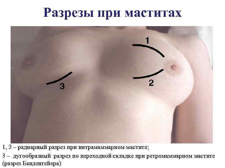 Разрезы при маститах 1, 2 – радиарный разрез при интрамаммарном мастите; 3 – дугообразный