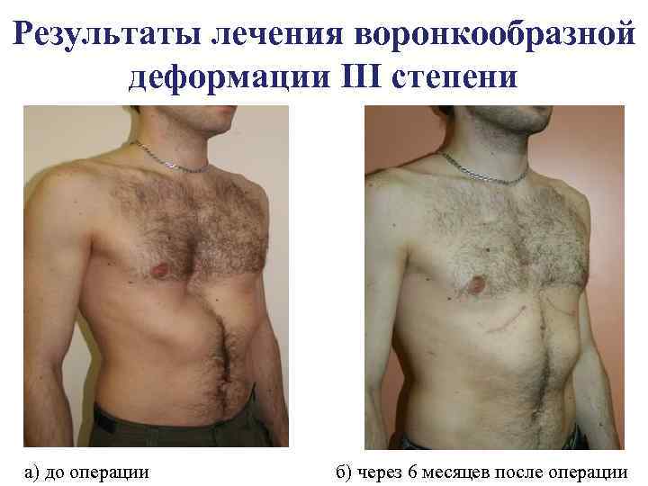 Результаты лечения воронкообразной деформации III степени а) до операции б) через 6 месяцев после
