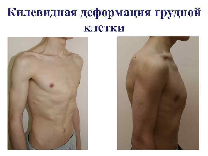 Килевидная деформация грудной клетки 