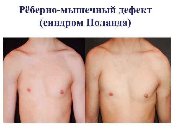 Рёберно-мышечный дефект (синдром Поланда) 