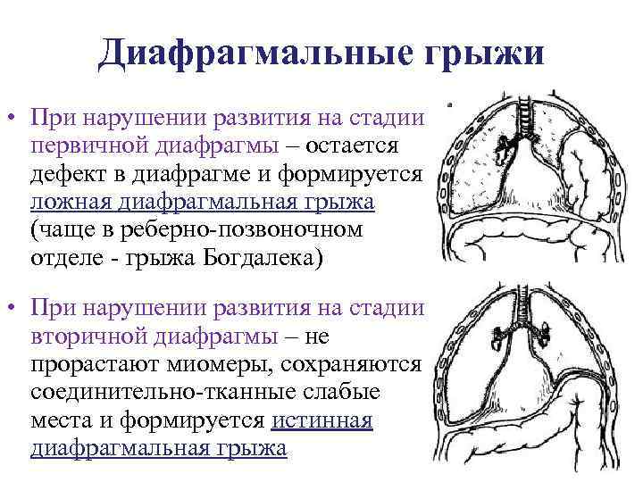 Диафрагмальные грыжи презентация хирургия