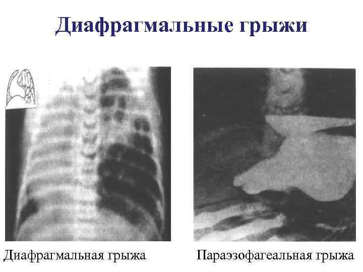Диафрагмальные грыжи Диафрагмальная грыжа Параэзофагеальная грыжа 