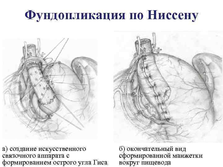 Фундопликация по Ниссену а) создание искусственного связочного аппарата с формированием острого угла Гиса б)