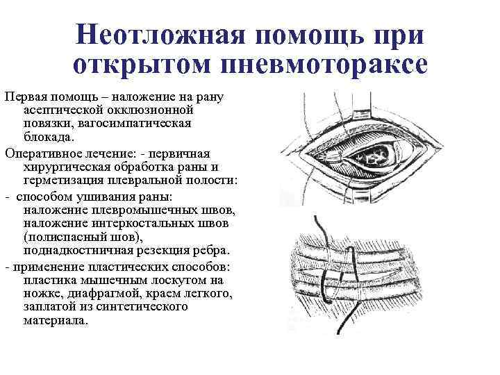 Неотложная помощь при открытом пневмотораксе Первая помощь – наложение на рану асептической окклюзионной повязки,