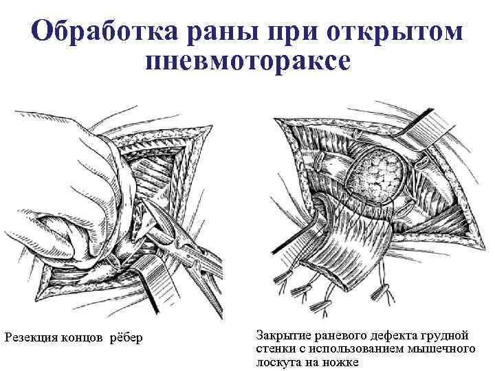 Обработка раны при открытом пневмотораксе Резекция концов рёбер Закрытие раневого дефекта грудной стенки с