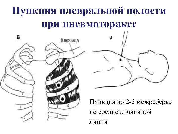 Схема строения межреберного промежутка