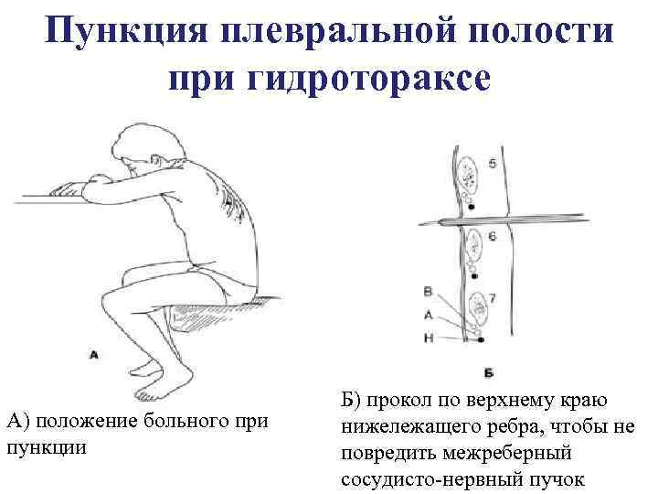 Пункция плевральной полости презентация