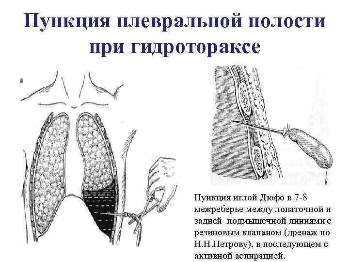 Пункция плевральной полости презентация