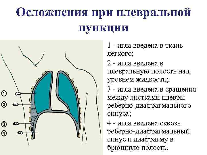 Плевральная пункция картинки