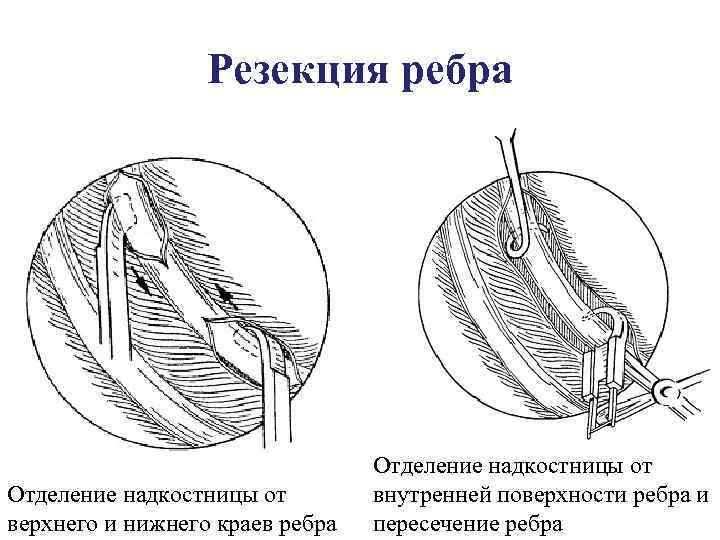 Резекция ребра Отделение надкостницы от верхнего и нижнего краев ребра Отделение надкостницы от внутренней