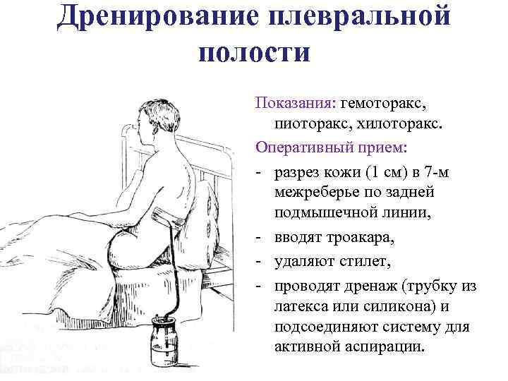 Дренирование плевральной полости Показания: гемоторакс, пиоторакс, хилоторакс. Оперативный прием: разрез кожи (1 см) в