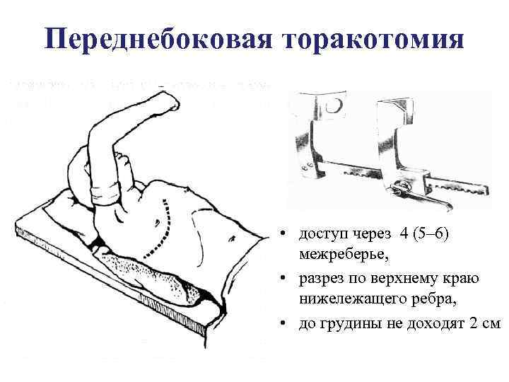 Мечевидный отросток у новорожденного фото