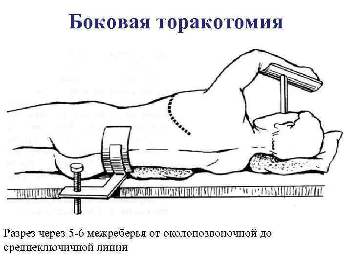 Боковой разрез. Торакотомия грудной клетки. Переднебоковая торакотомия в 5 межреберье. Левосторонняя боковая торакотомия. Переднебоковая торакотомия.