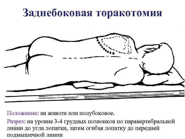 Заднебоковая торакотомия Положение: на животе или полубоковое. Разрез: на уровне 3 4 грудных позвонков