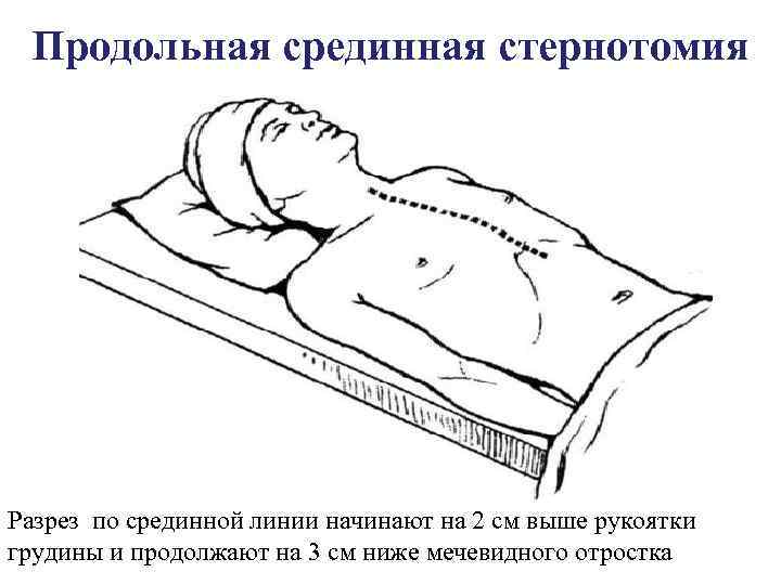 Продольная срединная стернотомия Разрез по срединной линии начинают на 2 см выше рукоятки грудины