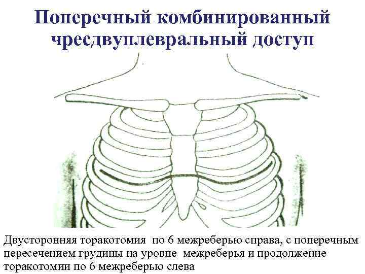 Поперечный комбинированный чресдвуплевральный доступ Двусторонняя торакотомия по 6 межреберью справа, с поперечным пересечением грудины