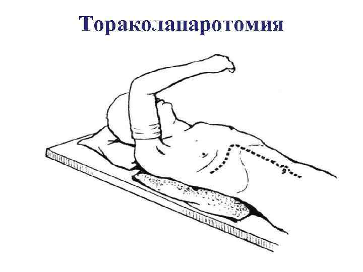 Тораколапаротомия 
