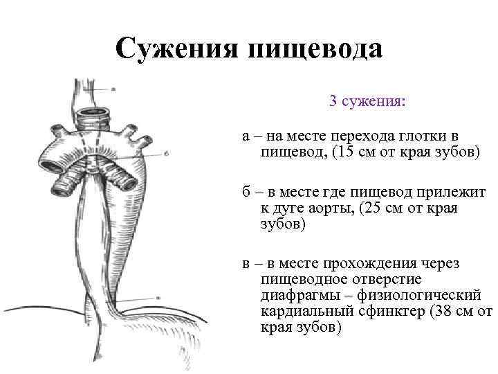 Сужения пищевода 3 сужения: а – на месте перехода глотки в пищевод, (15 см