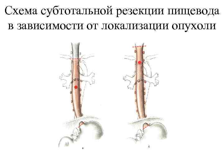 Схема субтотальной резекции пищевода в зависимости от локализации опухоли 