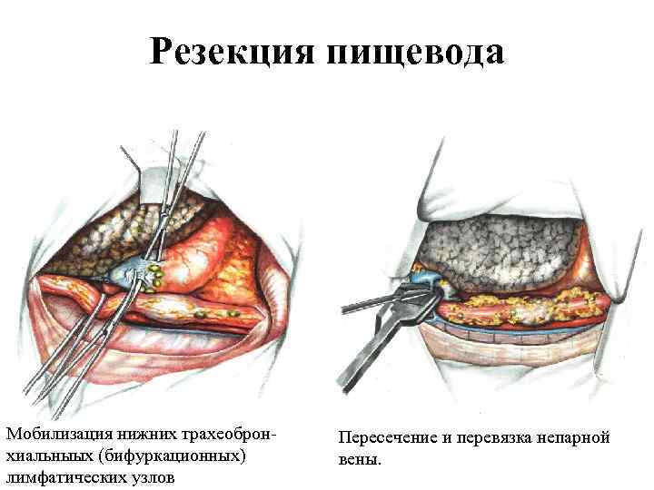 Резекция пищевода Мобилизация нижних трахеоброн хиальныых (бифуркационных) лимфатических узлов Пересечение и перевязка непарной вены.